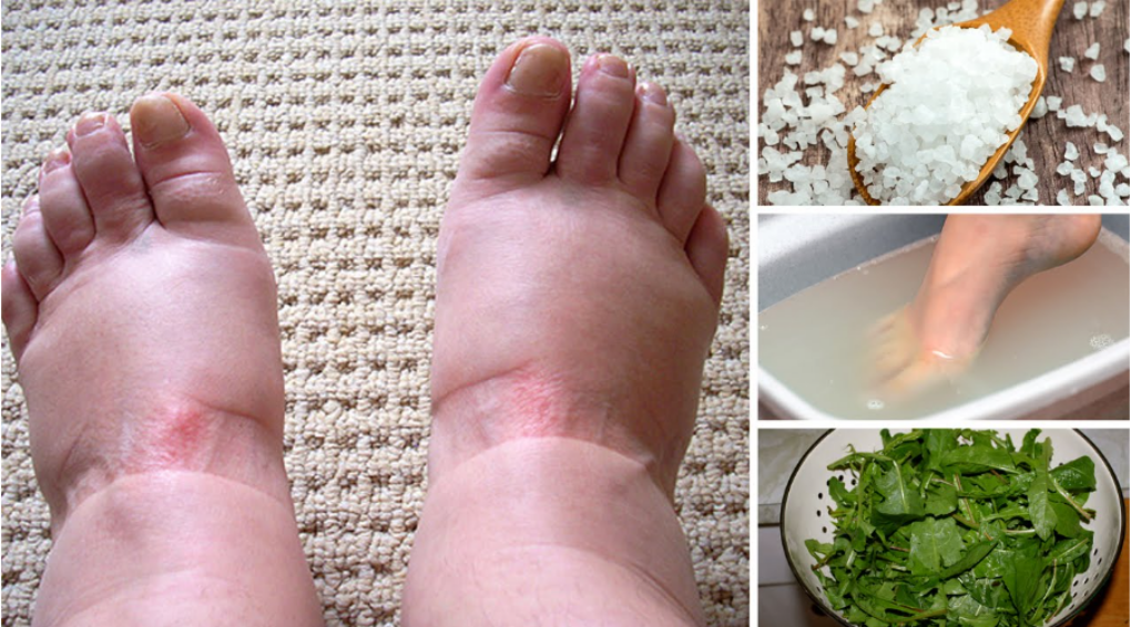 home remedy to ease swollen feet